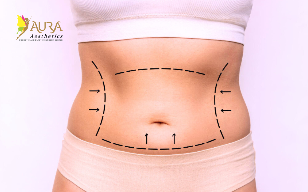 Tummy Tuck Surgery in Hyderabad: Remarkable & Trusted Care